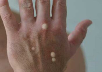 España pone fin al mes de agosto superando los 6.500 casos de viruela del mono