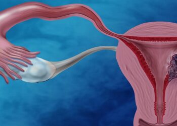 Diseñan un test de detección de cáncer de endometrio para realizarlo en casa