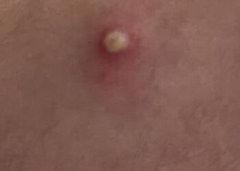 Detectan el primer caso de coinfección de viruela del mono: un italiano que estuvo en España