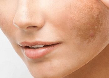 La excesiva exposición solar, unido a factores genéticos y hormonales, puede originar manchas en la piel