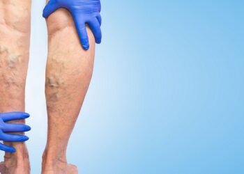 La insuficiencia venosa crónica aumenta su incidendia con la edad