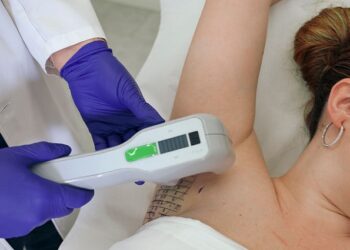 Adiós a la sudoración excesiva axilar: Miradry ofrece una solución definitiva