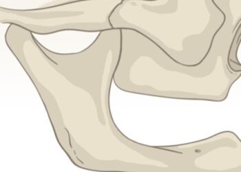 Cómo tratar la atrofia severa del hueso maxilar mandibular