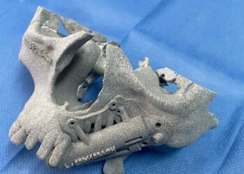 Los implantes cigomáticos mediante cirugía guiada son una solución segura para la rehabilitación de maxilares atróficos o secuelas de tumores