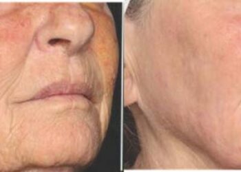 Revolución estética en Clínica Dermatológica Internacional (CDI) al incorporar el láser frío regenerativo que combate todos los signos de la edad